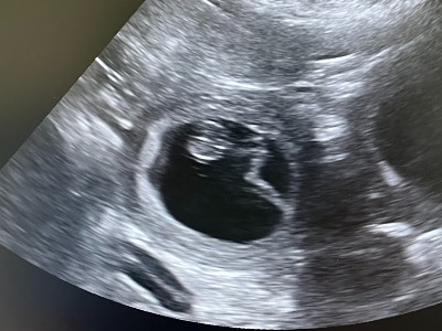 ECHOGRAPHIE URSAXORSO 2025 5438